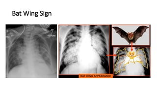 Chest x-ray INTERPRETATION AND signs.pptx