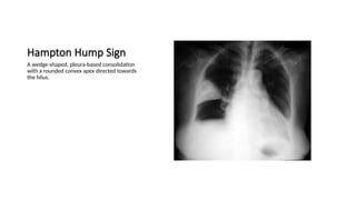 Chest x-ray INTERPRETATION AND signs.pptx