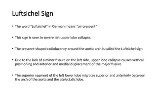 Luftcycle Sign Chest x-ray INTERPRETATION AND signs.pptx