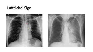 Luftcycle Sign Chest x-ray INTERPRETATION AND signs.pptx