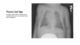 Triangular Sign Chest Chest x-ray INTERPRETATION AND signs.pptx