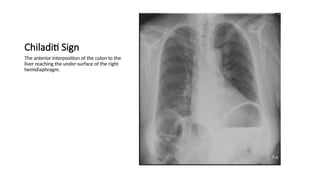 Chest x-ray INTERPRETATION AND signs.pptx