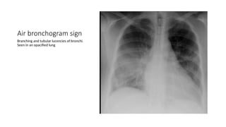 Chest x-ray INTERPRETATION AND signs.pptx
