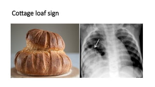 Meatloaf Sign Chest x-ray INTERPRETATION AND signs.pptx