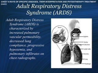 Chest x rays of specific diseases, their interpretation | PPT