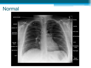Chest X-RayTMH 2019.pptx