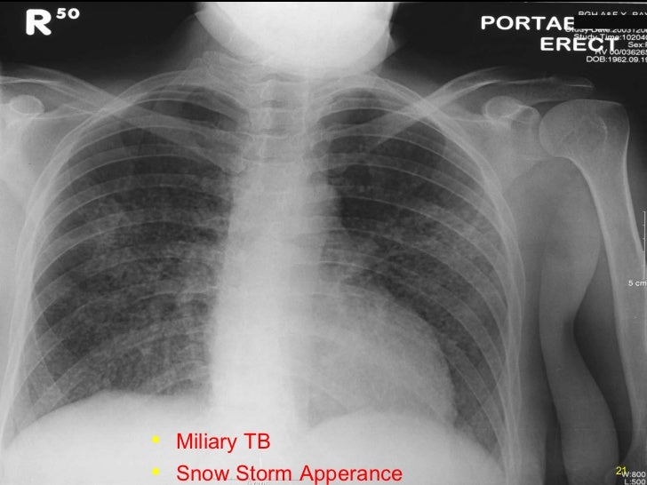 Chest xray