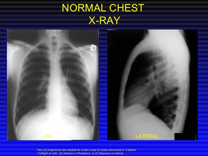 Chest xray