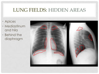 Normal Chest X-ray | PPTX
