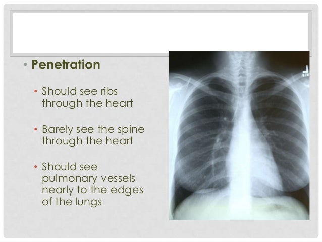 Normal Chest X Ray