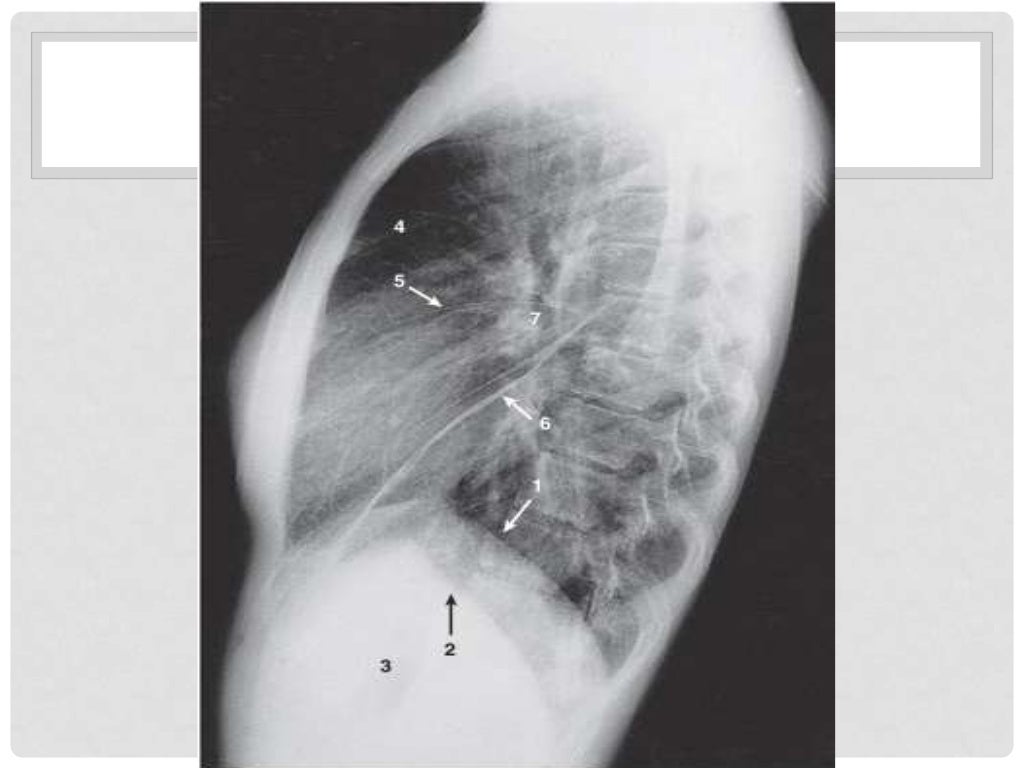 normal chest xray normal chest xray