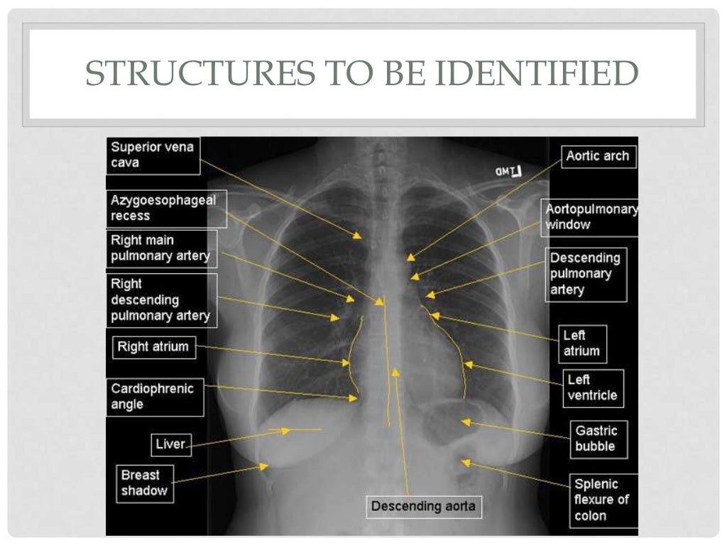 Normal Chest Xray