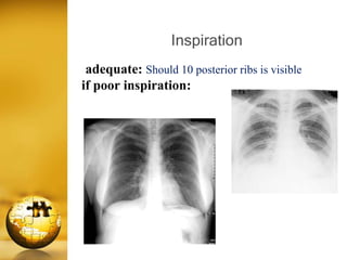 Inspiration Normal Ribs Chest x ray basic knowledge | PPTX