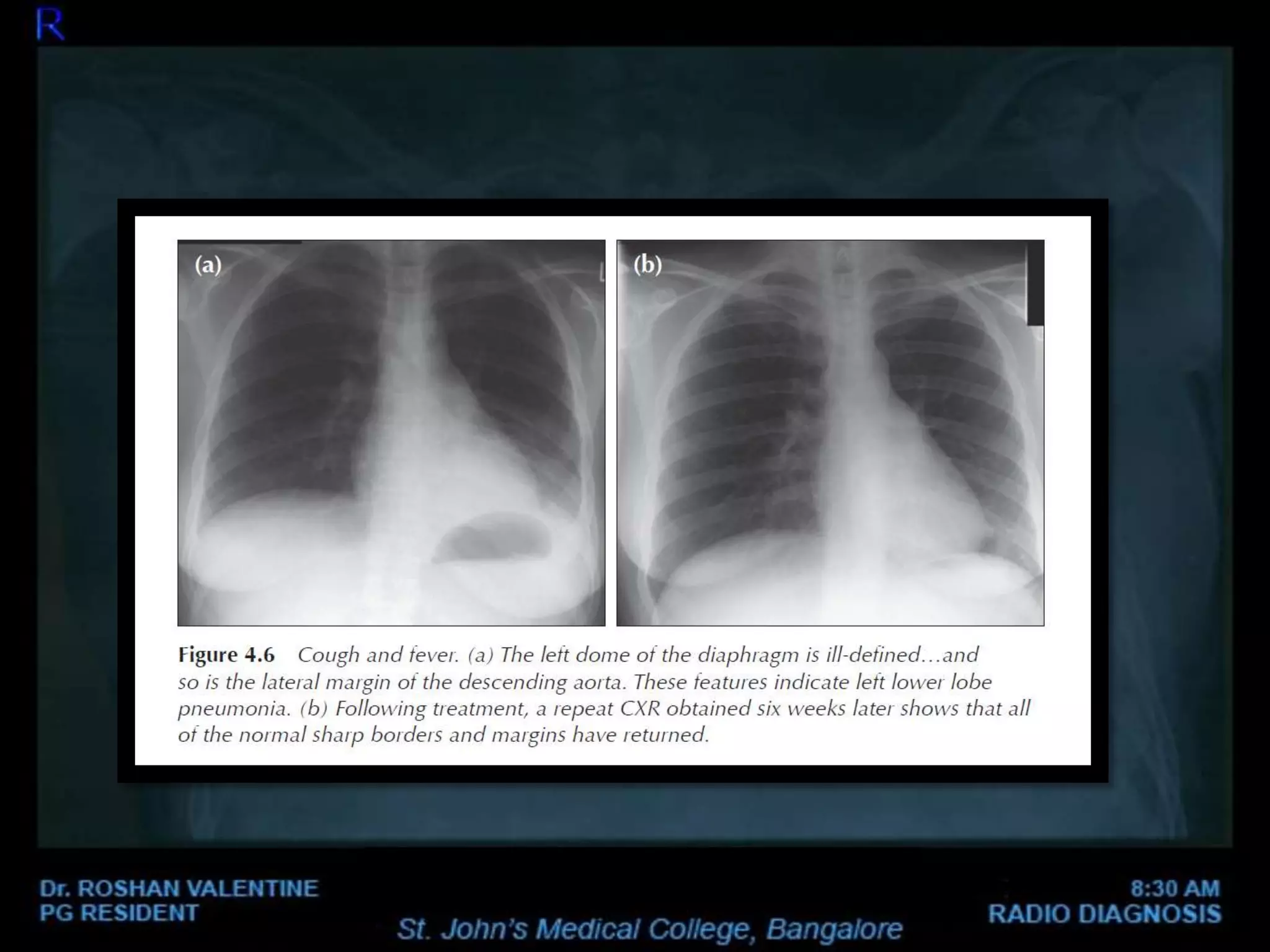 Abnormal Chest xray | PPTX