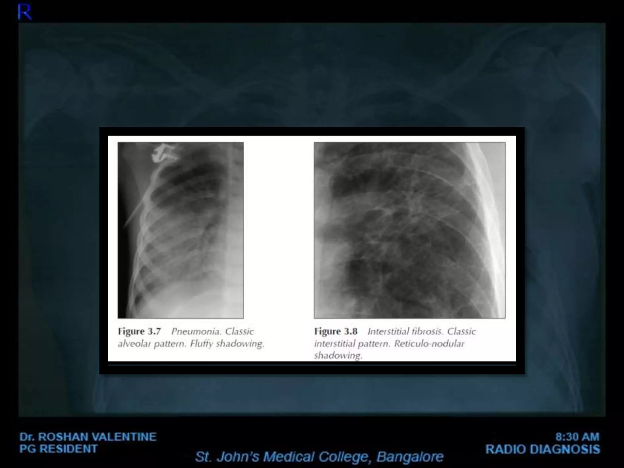 Abnormal Chest xray | PPTX