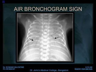 AIR BRONCHOGRAM SIGN
 