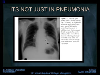 ITS NOT JUST IN PNEUMONIA
 