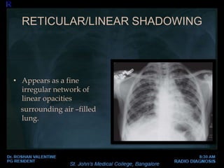 Abnormal Chest xray | PPTX
