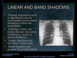 LINEAR AND BAND SHADOWS
• Normal structures such
as the blood vessels
and fissures form linear
shadows within the
lung fields.
• However, there are
many disease processes
which may result in
linear shadows.
• Linear shadows are
less than 5 mm wide,
• Band shadows are
greater than 5 mm thick
.
 