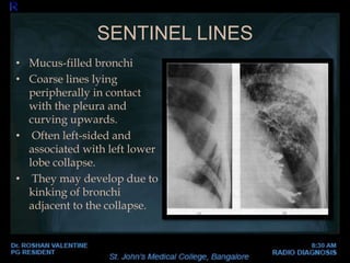 SENTINEL LINES
• Mucus-filled bronchi
• Coarse lines lying
peripherally in contact
with the pleura and
curving upwards.
• Often left-sided and
associated with left lower
lobe collapse.
• They may develop due to
kinking of bronchi
adjacent to the collapse.
 