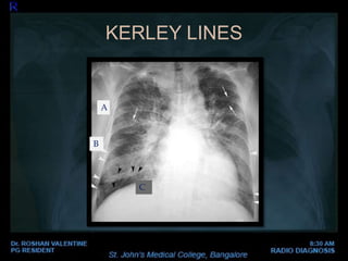 KERLEY LINES
B
A
C
 