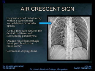 AIR CRESCENT SIGN
Crescent-shaped radiolucency
within a parenchymal
consolidation or nodular
opacity
Air fills the space between the
devitalized tissue and
surrounding parenchyma
Opaque rim of hemorrhagic
tissue peripheral to the
radiolucency
Common in Aspergilloma
 