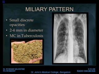 SOLITARY PULMONARY
NODULES
• Carcinomas often have irregular, spiculated or notched
margins.
• Calcification favours a ben...