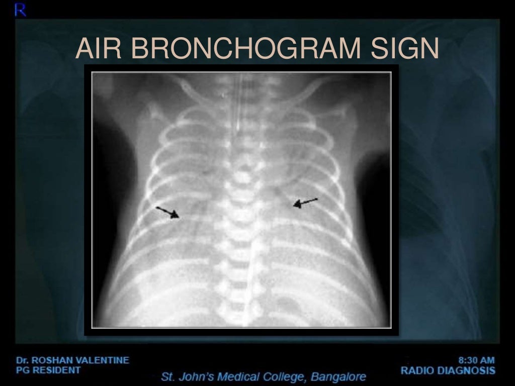 Abnormal Chest xray