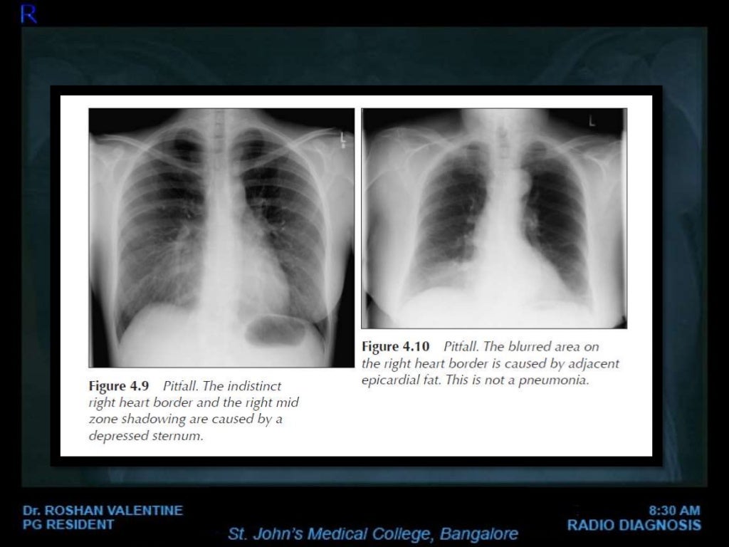 Abnormal Chest xray
