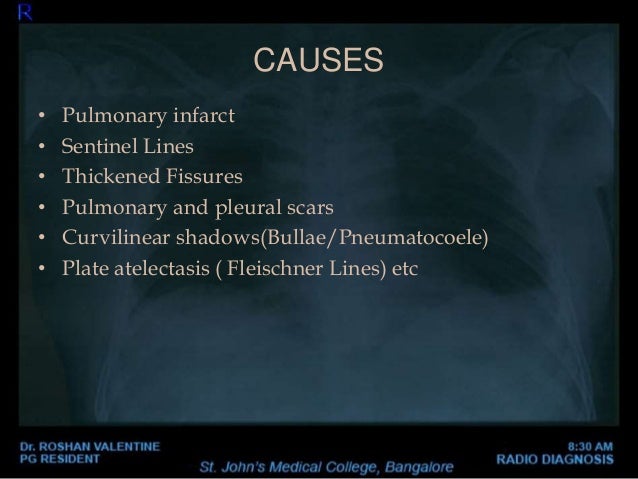 Abnormal Chest xray