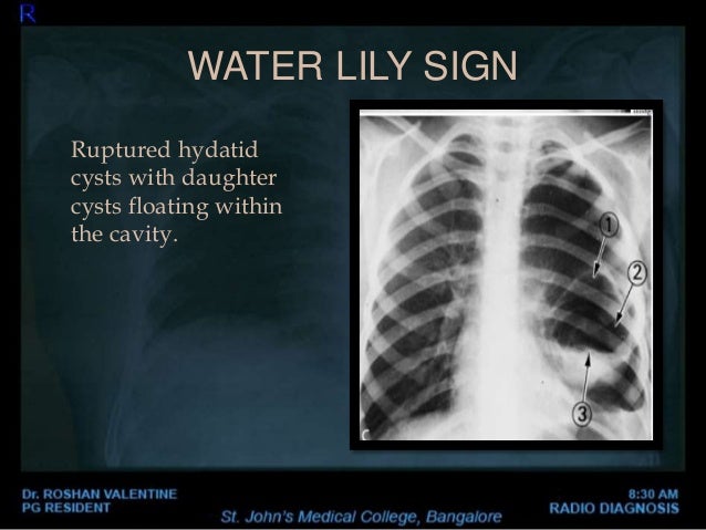 Pleural Tenting Radiology