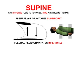 PLEURAL AIR GRAVITATES SUPERIORLY
PLEURAL FLUID GRAVITATES INFERIORLY
SUPINEMAY DISPERSE FLUID (EFFUSIONS) / HIDE AIR (PNEUMOTHORAX)
 