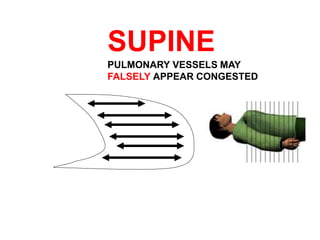 SUPINE
PULMONARY VESSELS MAY
FALSELY APPEAR CONGESTED
 