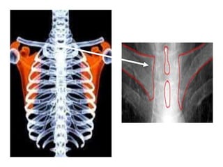 CLAVICLES
CLAVICLE ENDS ARE EQUI-
DISTANT FROM
VERTEBRAE
 