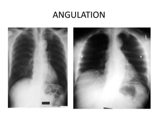 ANGULATION
 
