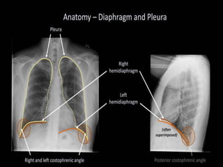 DIAPHRAGMATIC HUMPS
 