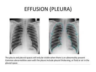 EFFUSION (PLEURA)
 
