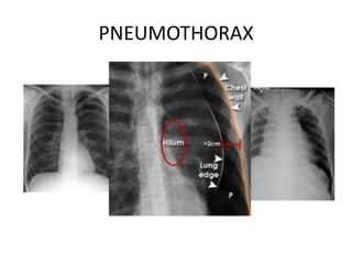 PNEUMOTHORAX
 