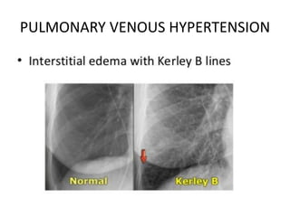 PULMONARY VENOUS HYPERTENSION
 