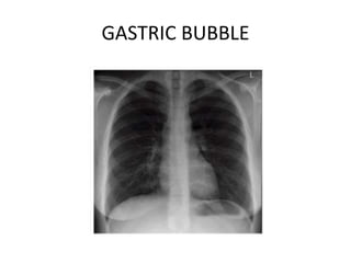 GASTRIC BUBBLE
 