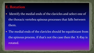 E. Rotation
 Identify the medial ends of the clavicles and select one of
the thoracic vertebra spinous processes that falls between
them.
 The medial ends of the clavicles should be equidistant from
the spinous process, if that’s not the case then the X-Ray is
rotated.
 
