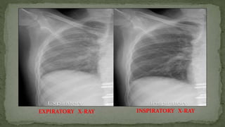 EXPIRATORY X-RAY INSPIRATORY X-RAY
 