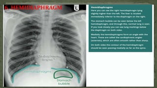 6. HEMIDIAPHRAGM
 