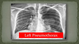 Left Pneumothorax
 