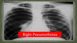 Right Pneumothorax
 