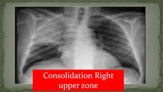 Consolidation Right
upper zone
 