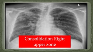 Consolidation Right
upper zone
 