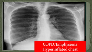 COPD/Emphysema
Hyperinflated chest
 