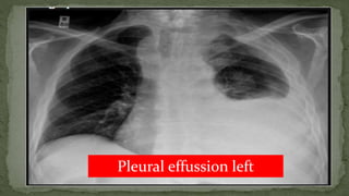 Pleural effussion left
 