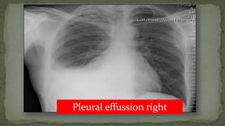 Pleural effussion right
 